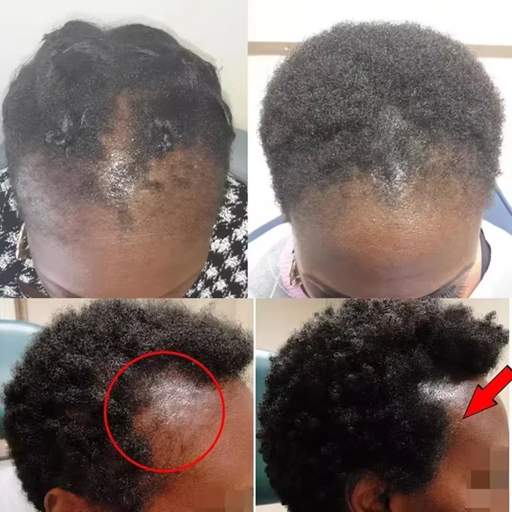 Fast Hair Growth Set Batana Oil Traction Alopecia Hair Mask anti Break Loss Hair Growth Oil Baldness Treatment Hair Health Care